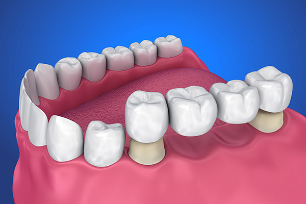 Tooth Loss & Replacement Options