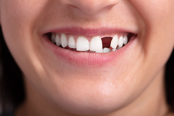 Tooth Loss & Replacement Options